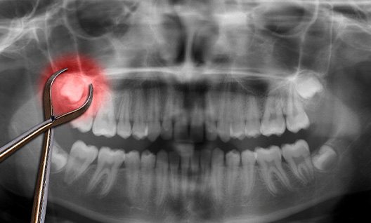 X-ray image of teeth with wisdom tooth highlight red surrounded by forceps