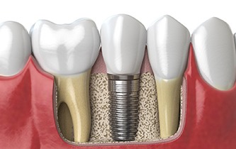 Fully integrated dental implant with a crown attached
