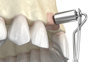 Digital diagram of bone graft for dental implants in Little Rock