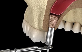 Digital diagram of sinus lift for dental implants in Little Rock