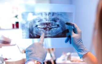Little Rock implant dentist pointing to X-ray before ridge expansion