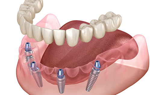 Illustration of dentures being attached to dental implants