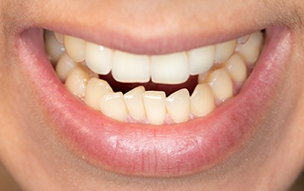 Closeup of a crooked smile