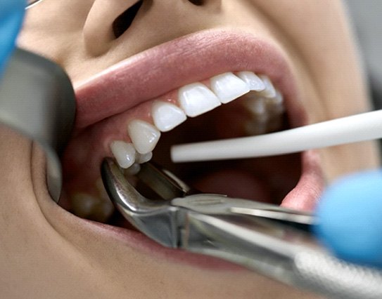 A woman receiving a tooth extraction treatment