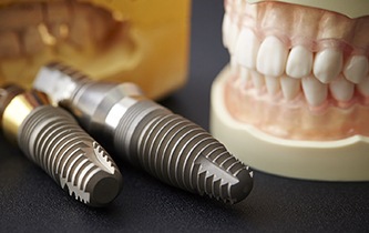 a model of dental implants sitting next to a plaster cast of a mouth