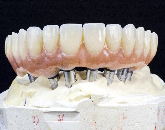 a model of an implant denture