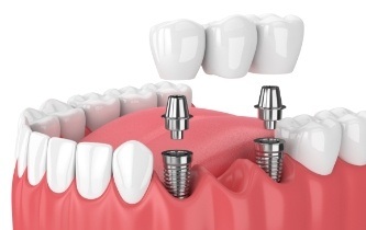 Animated dental implant supported fixed bridge placement