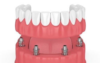 Animated implant supported denture placement