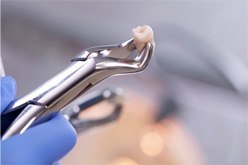 Forceps holding extracted tooth