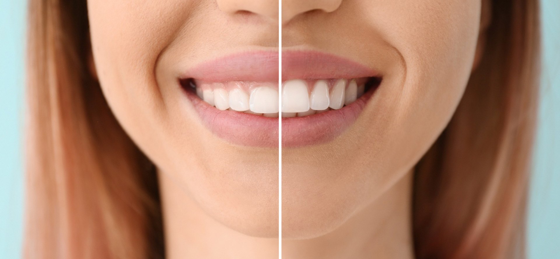 Gum recontouring can reshape your smile Gum recontouring is a surgical procedure that reshapes and reduces excess gum tissue.