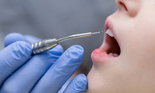  Gum recontouring is a surgical procedure that reshapes and reduces excess gum tissue.