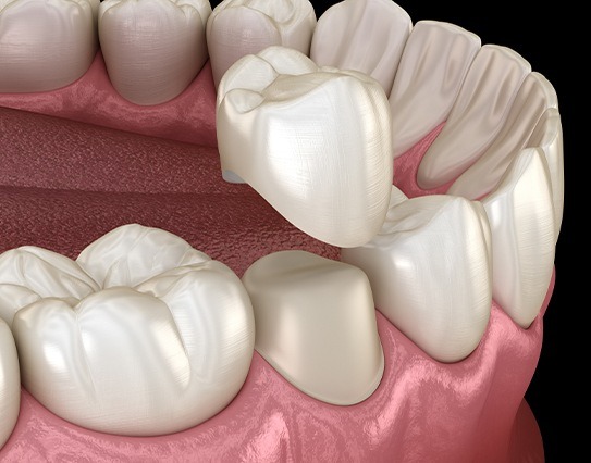 Animated dental crown placement process