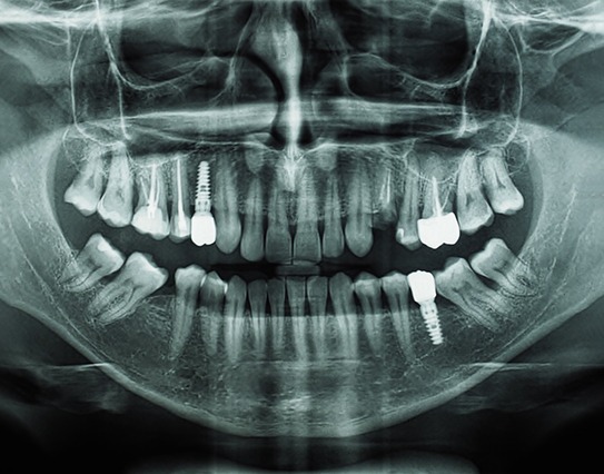 an X-ray of a failed dental implant in Little Rock
