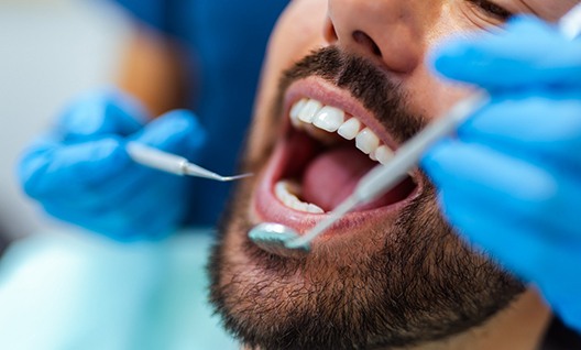 A man’s mouth being examined by a dentist
