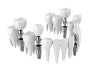 3D illustration of dental implants