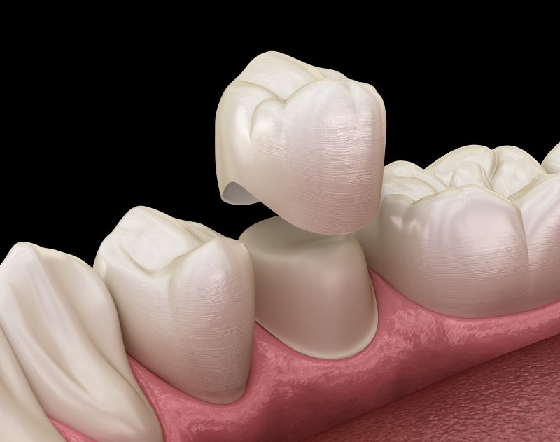 A 3D illustration of a dental crown