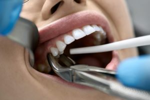 a woman having her tooth removed 