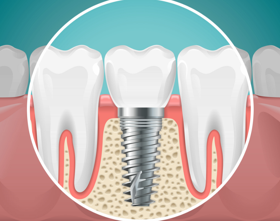 Illustrated cross section of a dental implant